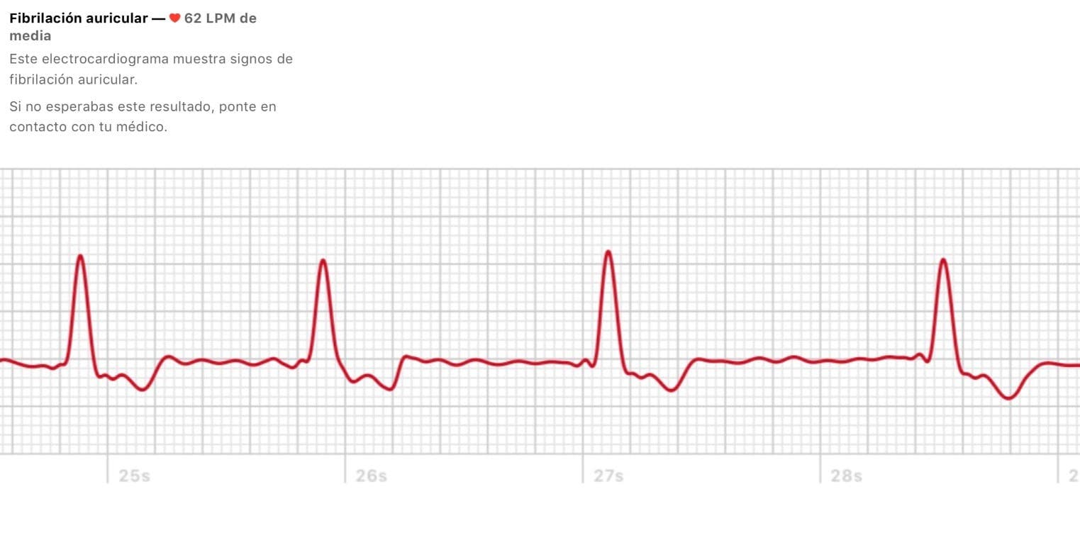 Nepravidelný rytmus a EKG upozornění, co to je a jak fungují 1603120304 613 Nepravidelny rytmus a EKG upozorneni co to je a jak