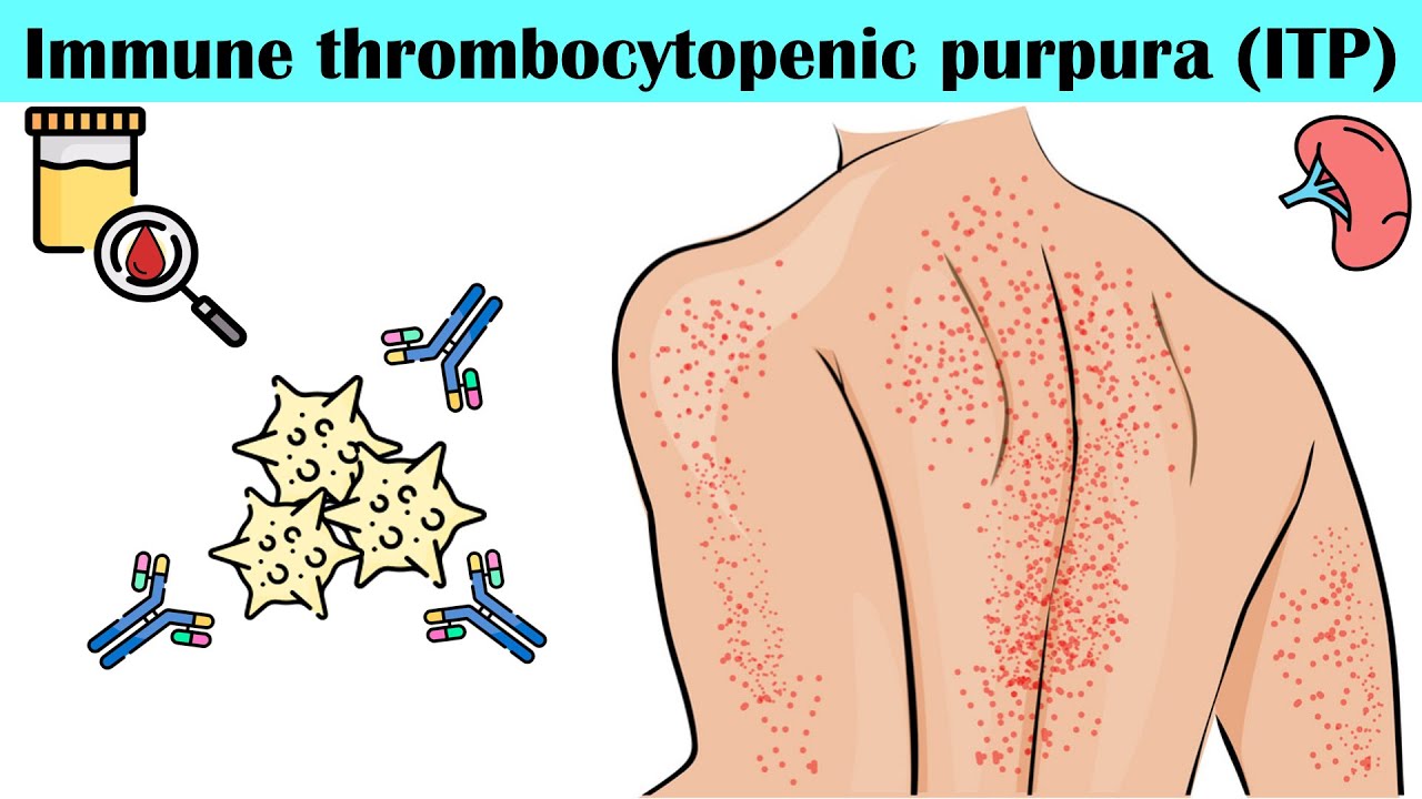 trombocytopenie